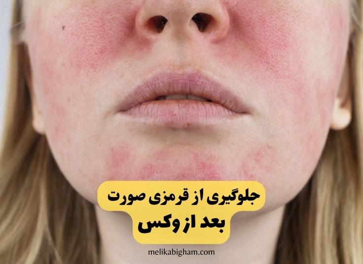 جلوگیری از قرمزی صورت