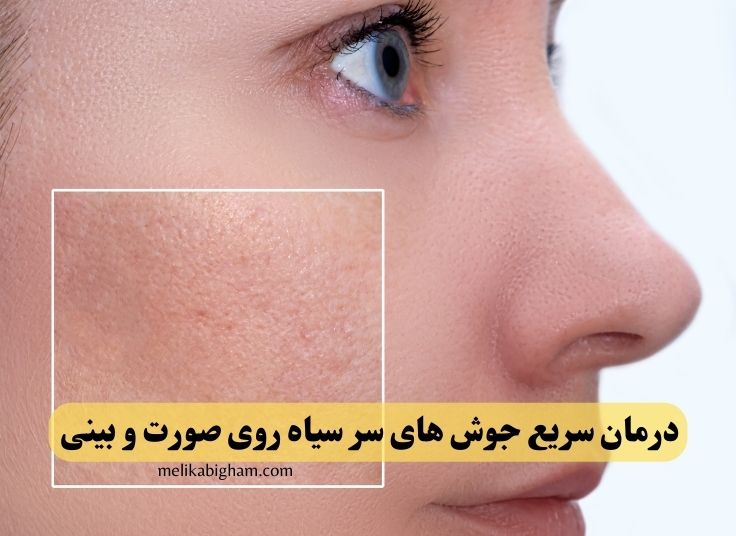 جوش های سر سیاه