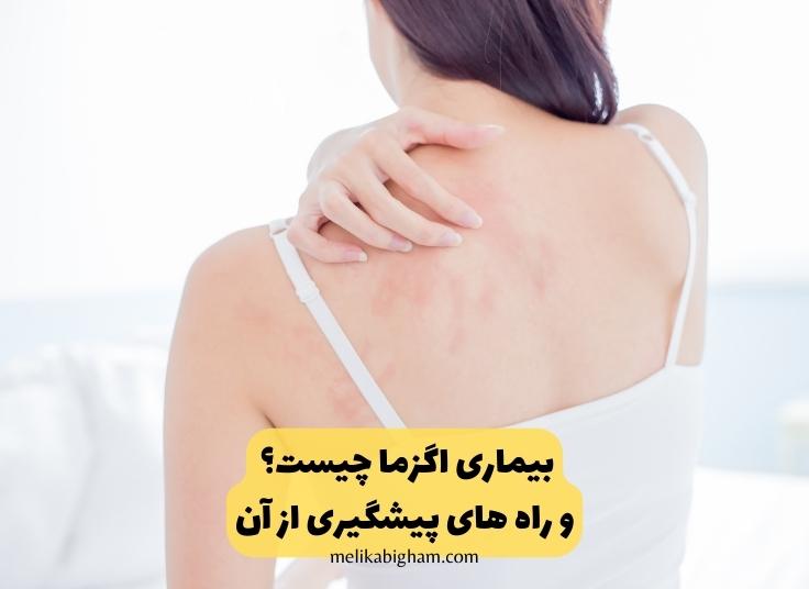 بیماری اگزما چیست؟ و راه های پیشگیری از آن